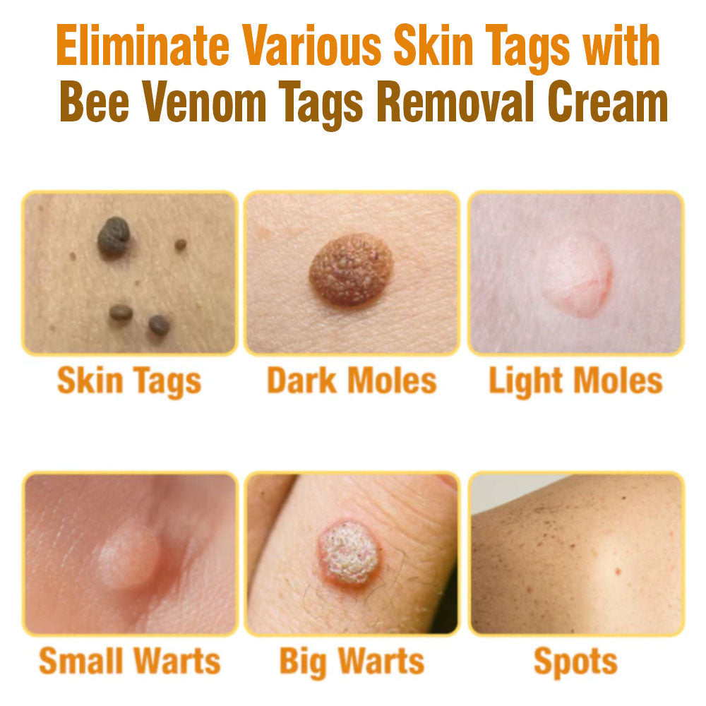 🏆✅FDA-APPROVED | flysmus™USA Bee Venom Tags Removal Cream